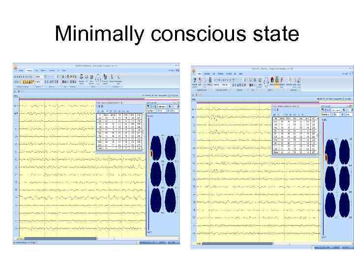 Minimally conscious state 