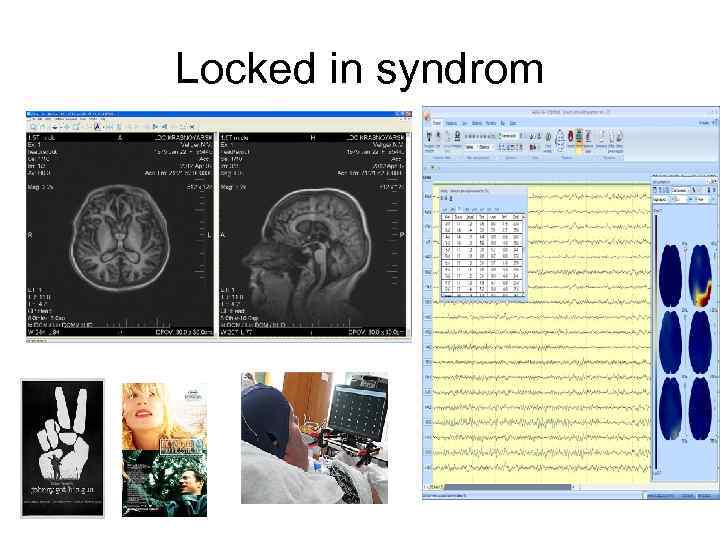 Locked in syndrom 