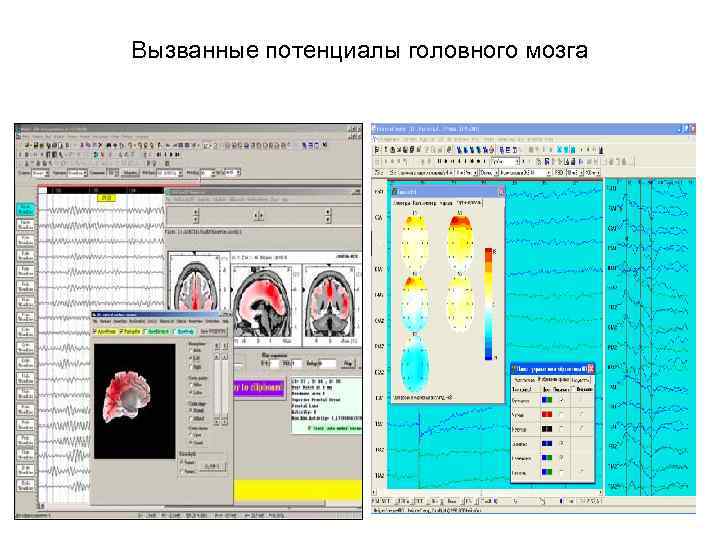 Вызванные потенциалы головного мозга 