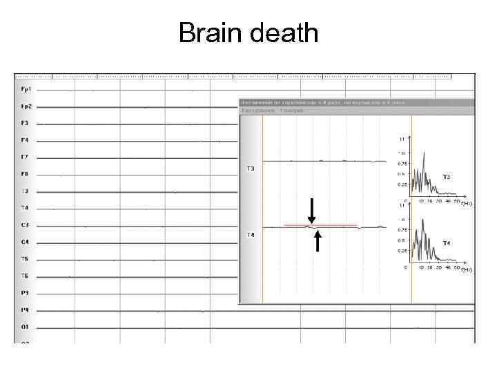 Brain death 