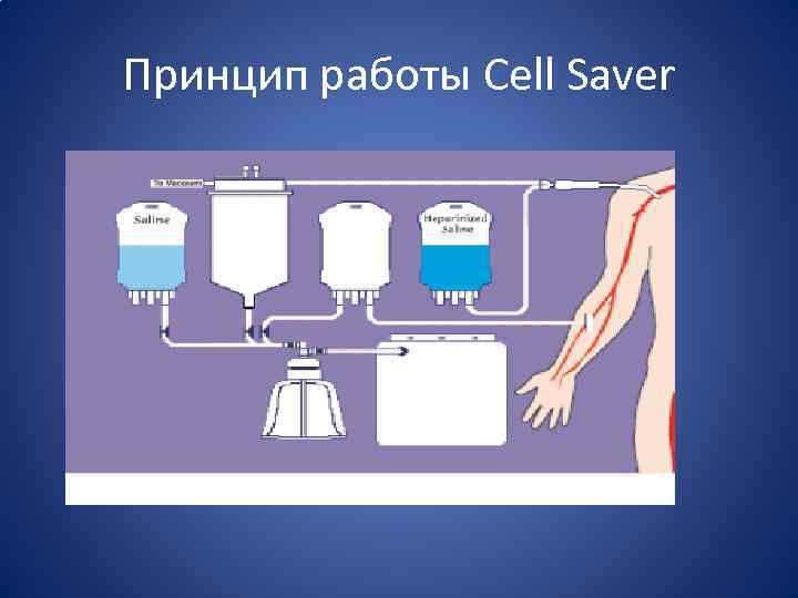 Принцип работы Cell Saver 