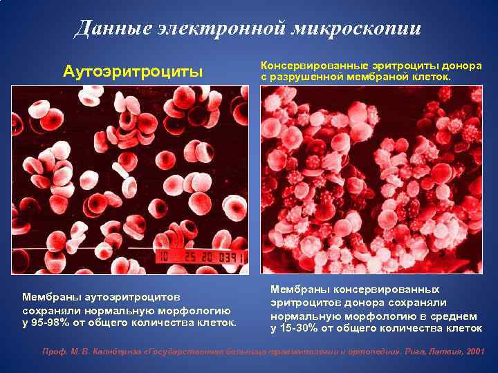 Данные электронной микроскопии Аутоэритроциты Мембраны аутоэритроцитов сохраняли нормальную морфологию у 95 -98% от общего