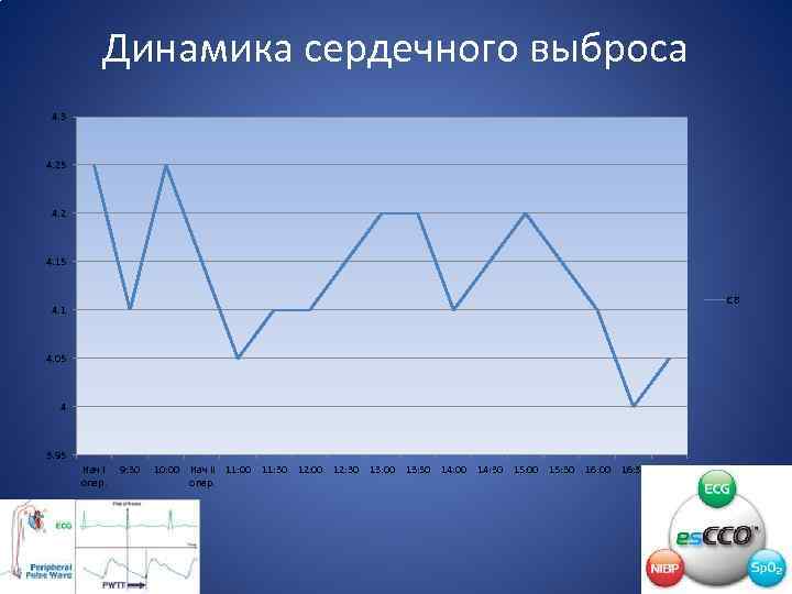 Динамика сердечного выброса 4. 3 4. 25 4. 2 4. 15 СВ 4. 1