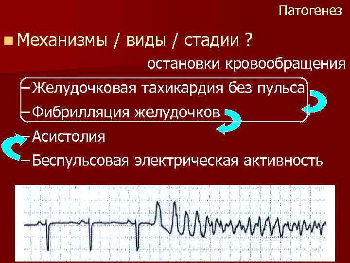 Патогенез n Механизмы / виды / стадии ? остановки кровообращения – Желудочковая тахикардия без