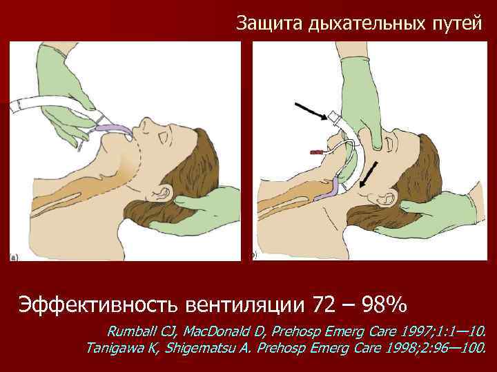 Защита дыхательных путей Эффективность вентиляции 72 – 98% Rumball CJ, Mac. Donald D, Prehosp