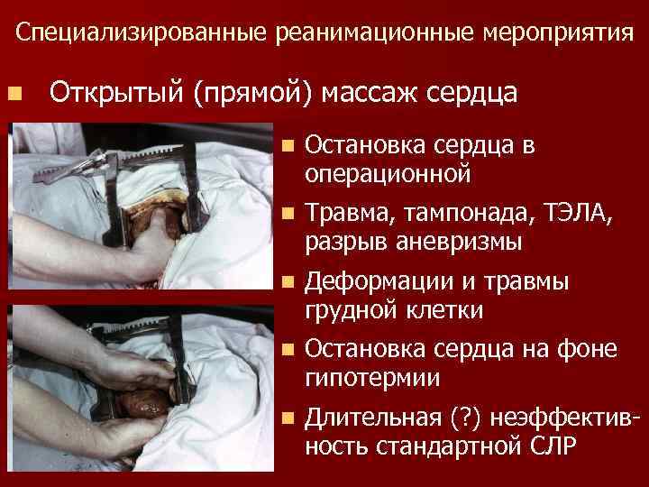 Специализированные реанимационные мероприятия n Открытый (прямой) массаж сердца n Остановка сердца в операционной n