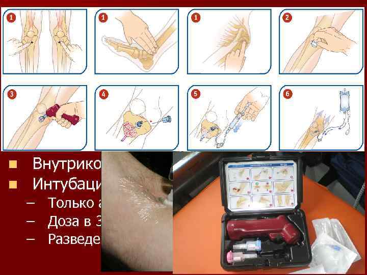 Пути введения препаратов при СЛР n Центральная вена – Оптимально, требует навыков, времени… n