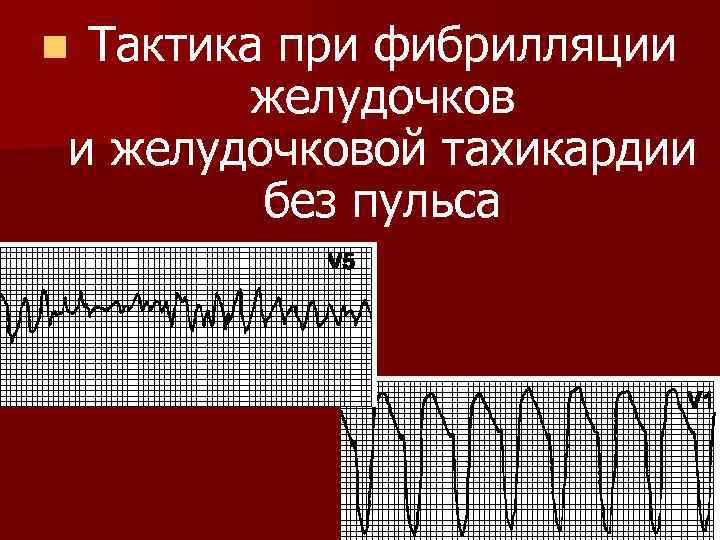 Тактика при фибрилляции желудочков и желудочковой тахикардии без пульса n 