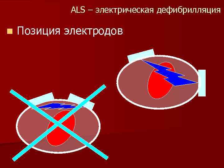ALS – электрическая дефибрилляция n Позиция электродов 