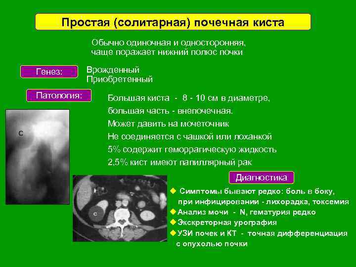 Лечение кисты почки без операции