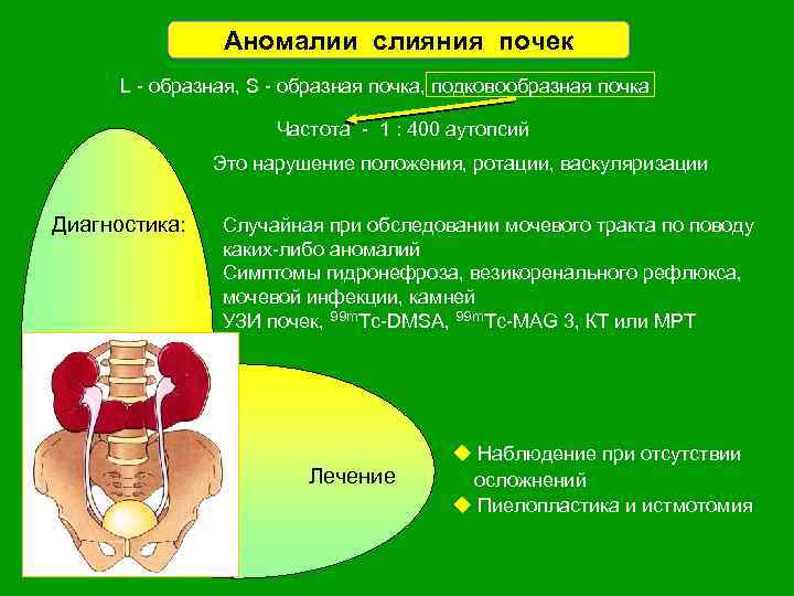 Аномалии слияния почек L - образная, S - образная почка, подковообразная почка Частота -