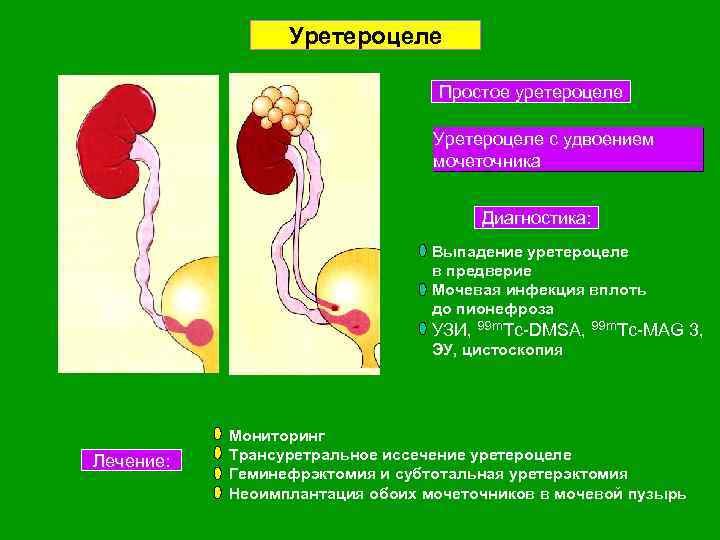 Уретероцеле Простое уретероцеле Рис. 14. 15 Уретероцеле с удвоением мочеточника Рис. 14. 13 третий