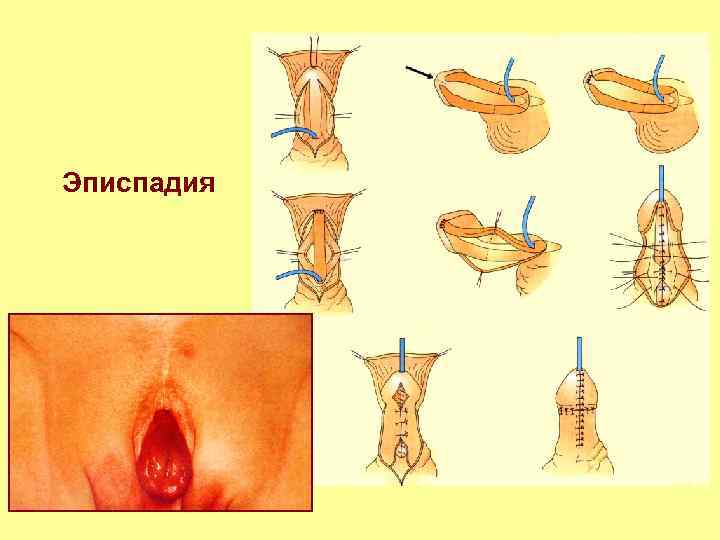 Эписпадия 