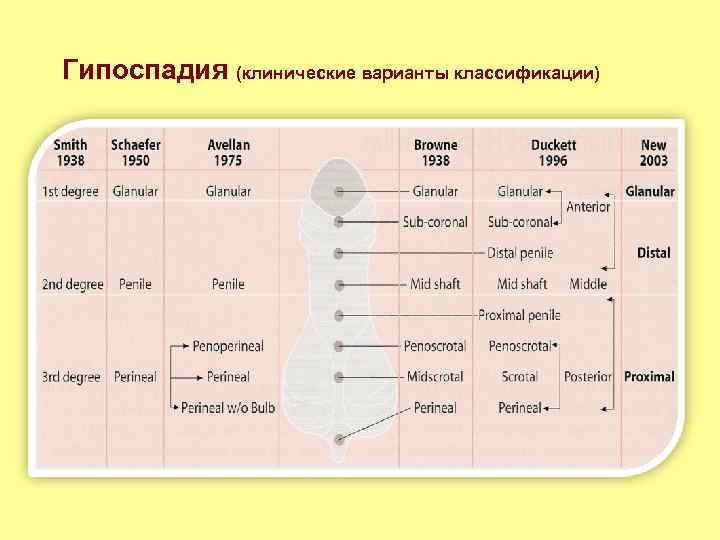 Гипоспадия (клинические варианты классификации) 