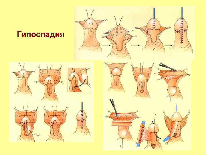 Гипоспадия 