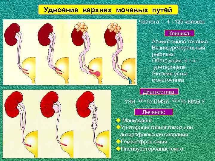 Удвоение мочеточника. Удвоение верхних мочевых путей это. Удвоение мочеточника классификация. Аномалии верхних мочевых путей.