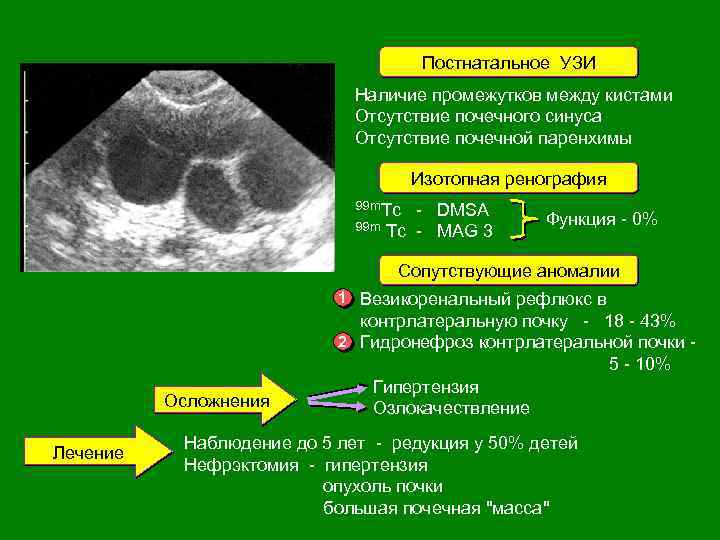 Постнатальное УЗИ Наличие промежутков между кистами Отсутствие почечного синуса Отсутствие почечной паренхимы Рис. 14.