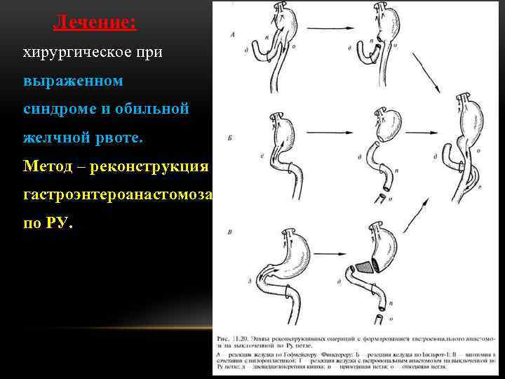 Лечение: хирургическое при выраженном синдроме и обильной желчной рвоте. Метод – реконструкция гастроэнтероанастомоза по