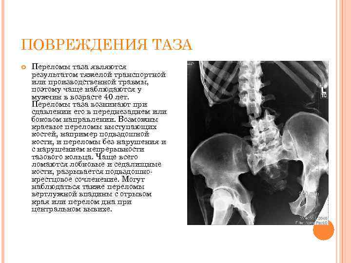 ПОВРЕЖДЕНИЯ ТАЗА Переломы таза являются результатом тяжелой транспортной или производственной травмы, поэтому чаще наблюдаются