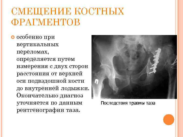 СМЕЩЕНИЕ КОСТНЫХ ФРАГМЕНТОВ особенно при вертикальных переломах, определяется путем измерения с двух сторон расстояния