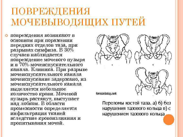 ПОВРЕЖДЕНИЯ МОЧЕВЫВОДЯЩИХ ПУТЕЙ повреждения возникают в основном при поражении передних отделов таза, при разрывах