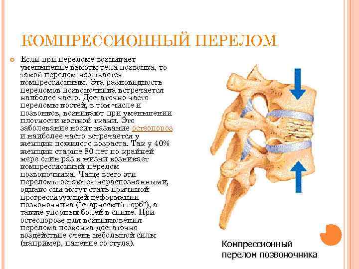 КОМПРЕССИОННЫЙ ПЕРЕЛОМ Если при переломе возникает уменьшение высоты тела позвонка, то такой перелом называется