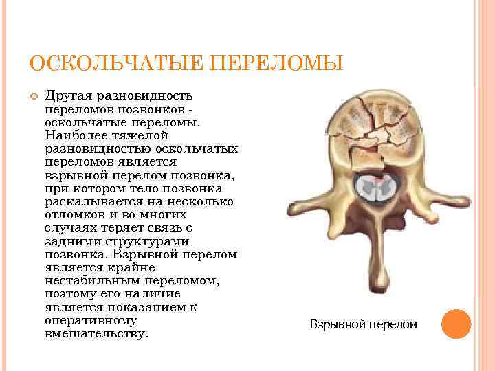 ОСКОЛЬЧАТЫЕ ПЕРЕЛОМЫ Другая разновидность переломов позвонков оскольчатые переломы. Наиболее тяжелой разновидностью оскольчатых переломов является