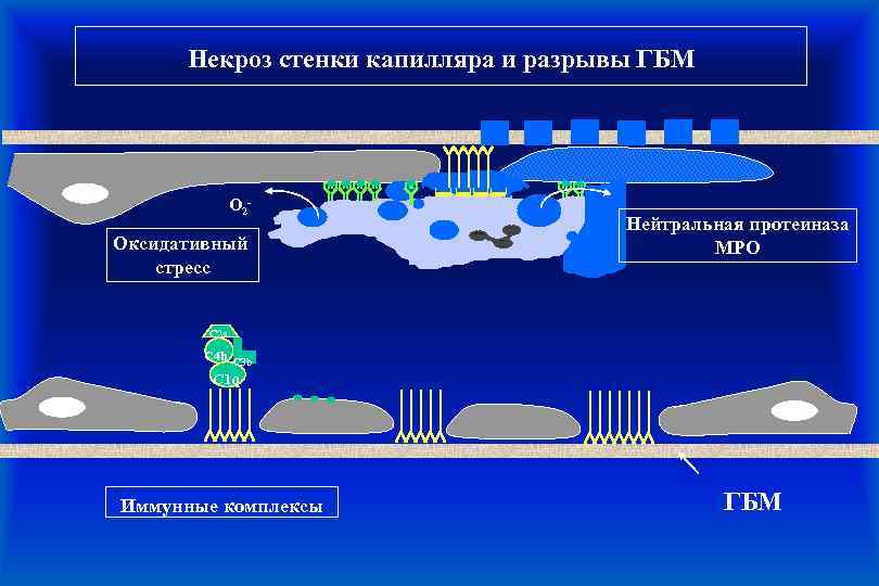 Некроз стенки капилляра и разрывы ГБМ O 2 - Оксидативный стресс Нейтральная протеиназа MPO