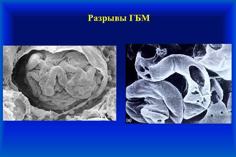 Разрывы ГБМ 
