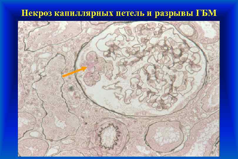 Некроз капиллярных петель и разрывы ГБМ 