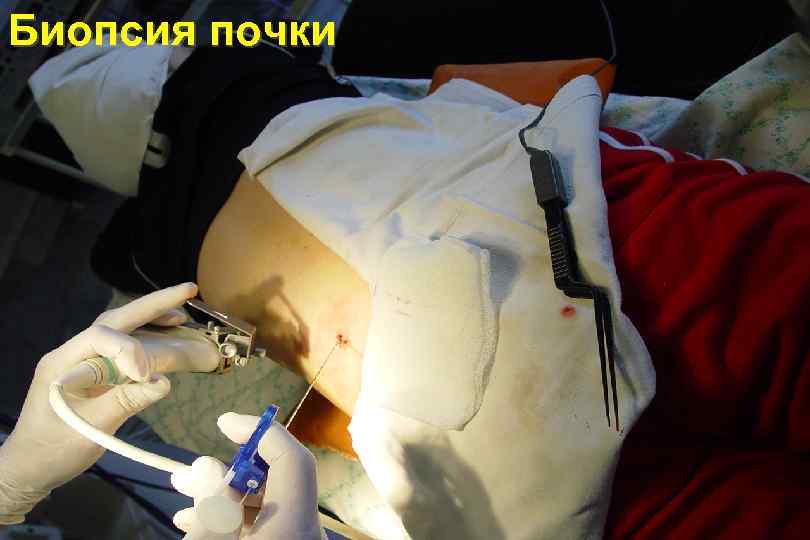 Биопсия почки 