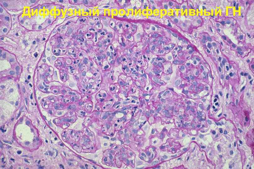 Диффузный пролиферативный ГН 