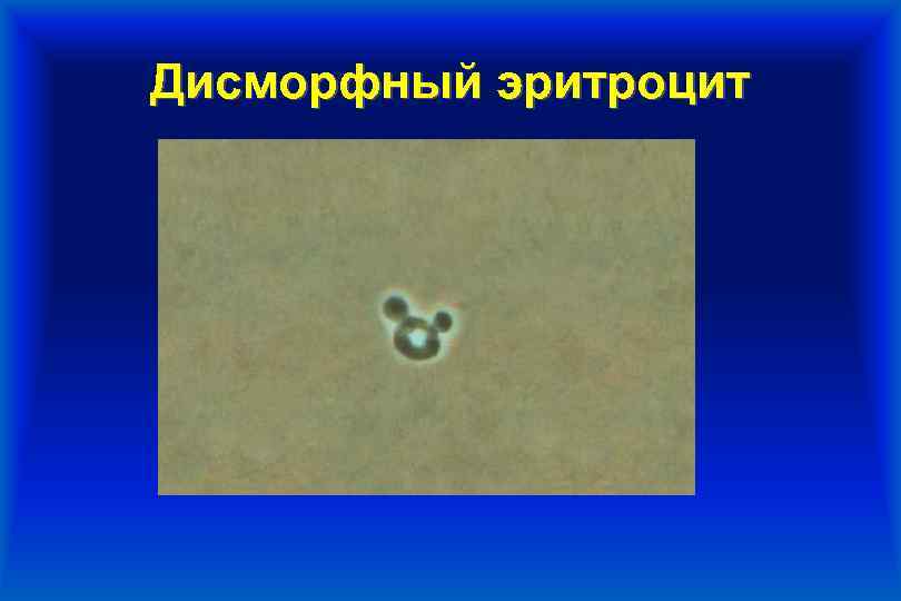 Дисморфный эритроцит 