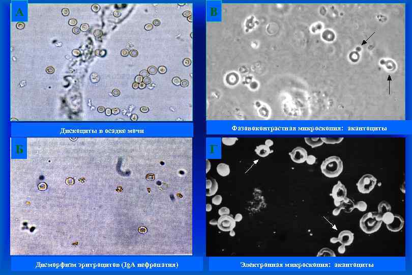 А В Фазовоконтрастная микроскопия: акантоциты Дискоциты в осадке мочи Б Г Дисморфизм эритроцитов (Ig.