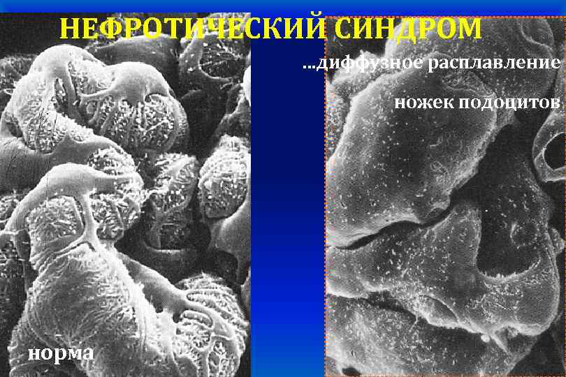 НЕФРОТИЧЕСКИЙ СИНДРОМ …диффузное расплавление ножек подоцитов норма 