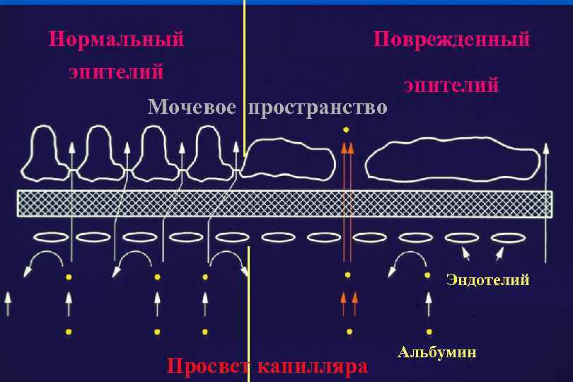 Нормальный эпителий Поврежденный Мочевое пространство эпителий Эндотелий Просвет капилляра Альбумин 