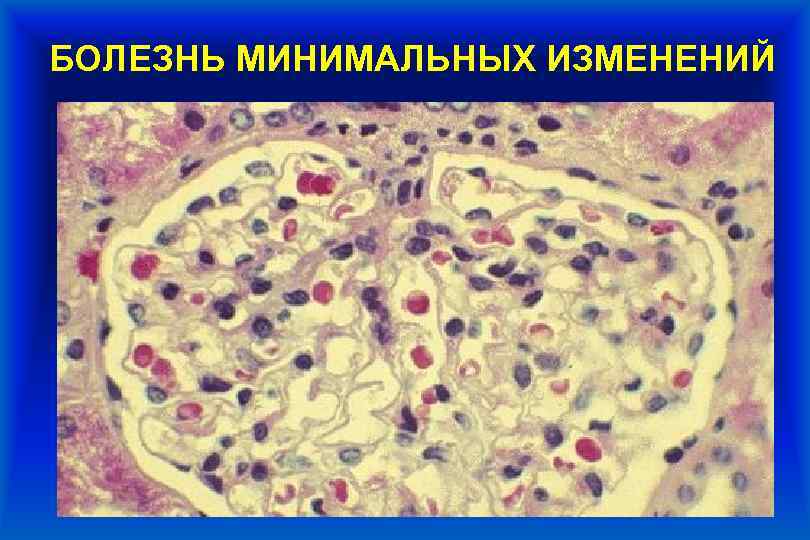 БОЛЕЗНЬ МИНИМАЛЬНЫХ ИЗМЕНЕНИЙ 