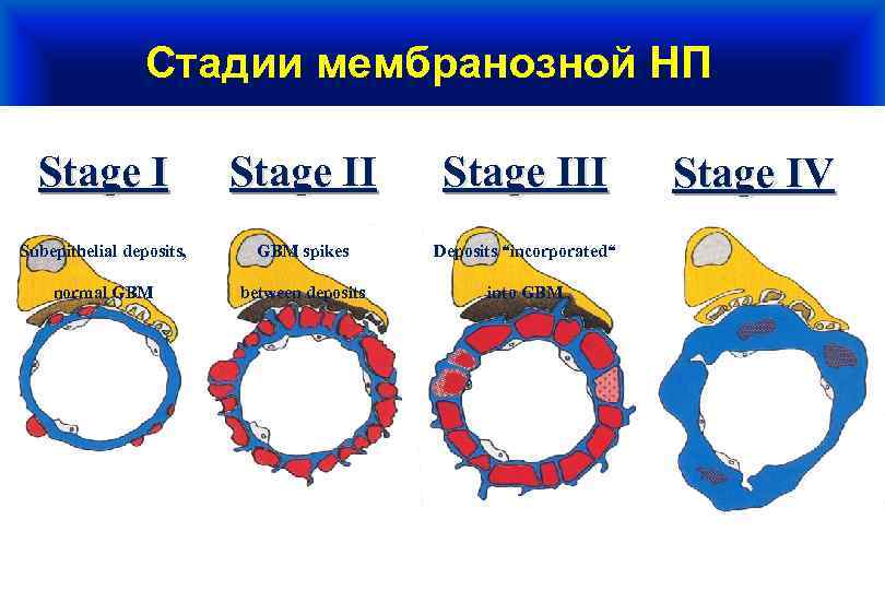Стадии мембранозной НП Stage III Stage IV Subepithelial deposits, GBM spikes Deposits “incorporated“ GBM