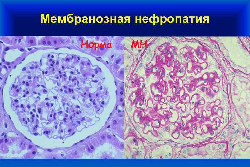Мембранозная нефропатия Норма МН 