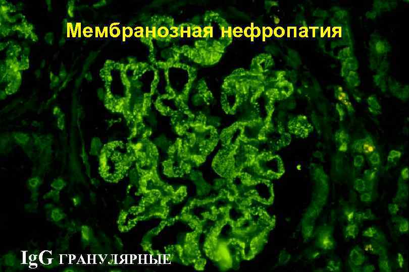 Мембранозная нефропатия Ig. G ГРАНУЛЯРНЫЕ 