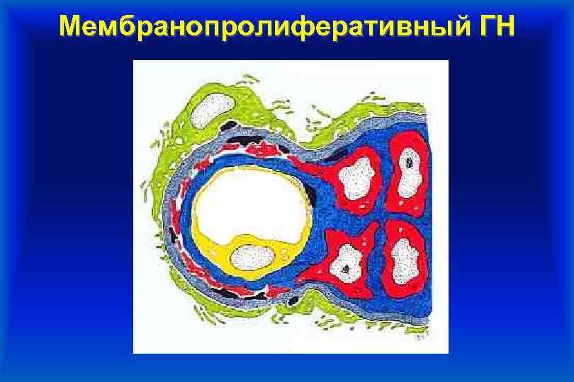 Мембранопролиферативный ГН 