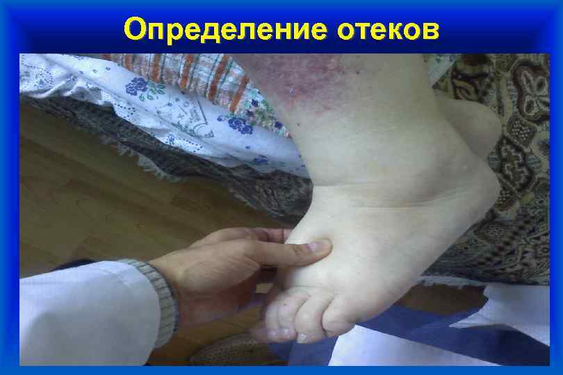 Определение отеков 