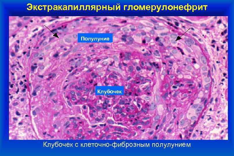 Микроскопическая картина мочи при гломерулонефрите