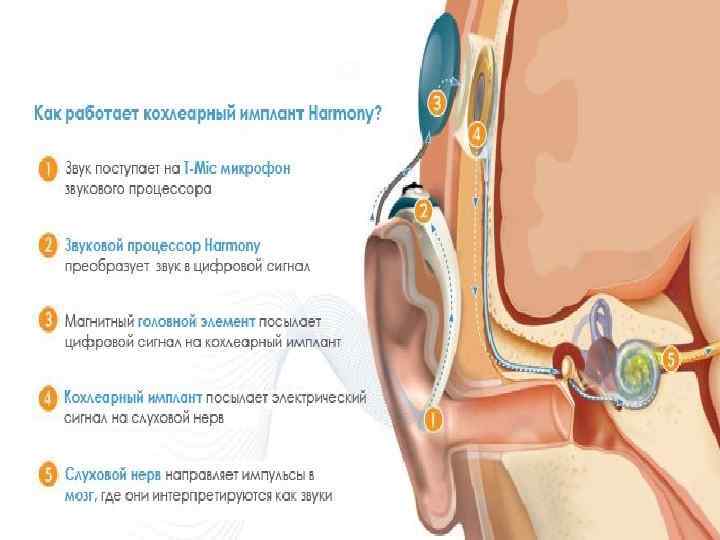 Схема работы кохлеарного импланта