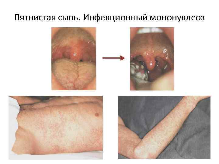 Пятнистая сыпь. Инфекционный мононуклеоз 