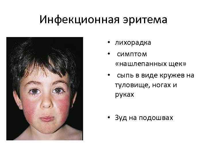 Инфекционная эритема сыпь фото