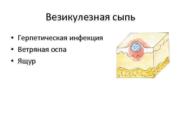 Везикулезная сыпь • Герпетическая инфекция • Ветряная оспа • Ящур 