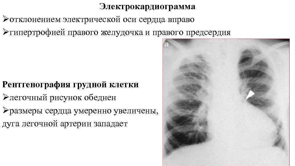 Рентген грудной клетки легочный рисунок усилен