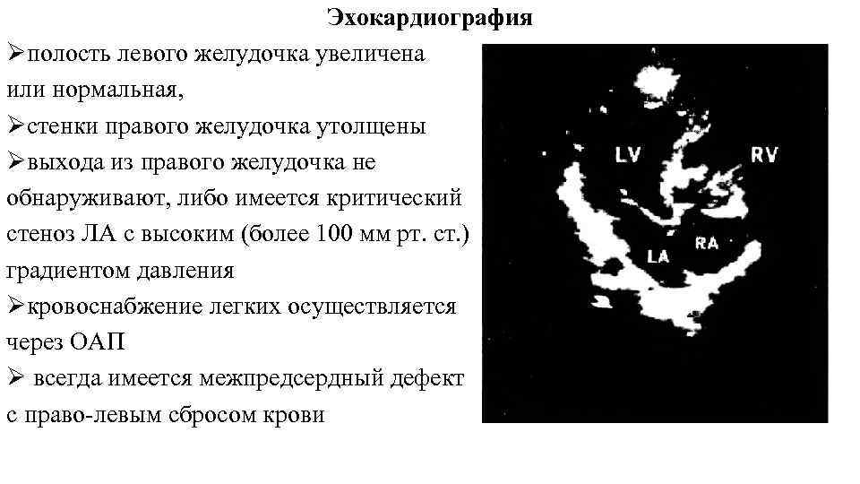 Эхокардиография Øполость левого желудочка увеличена или нормальная, Øстенки правого желудочка утолщены Øвыхода из правого