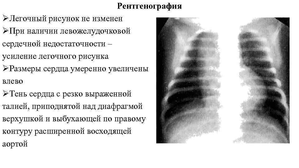 Легочный рисунок это. Рентгенография при левожелудочковой ХСН. Усиление легочного рисунка. Рентгенография что такое легочный рисунок. Легочный рисунок не Изменен.